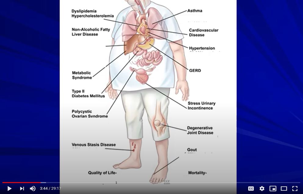 View the bariatric education video on YouTube